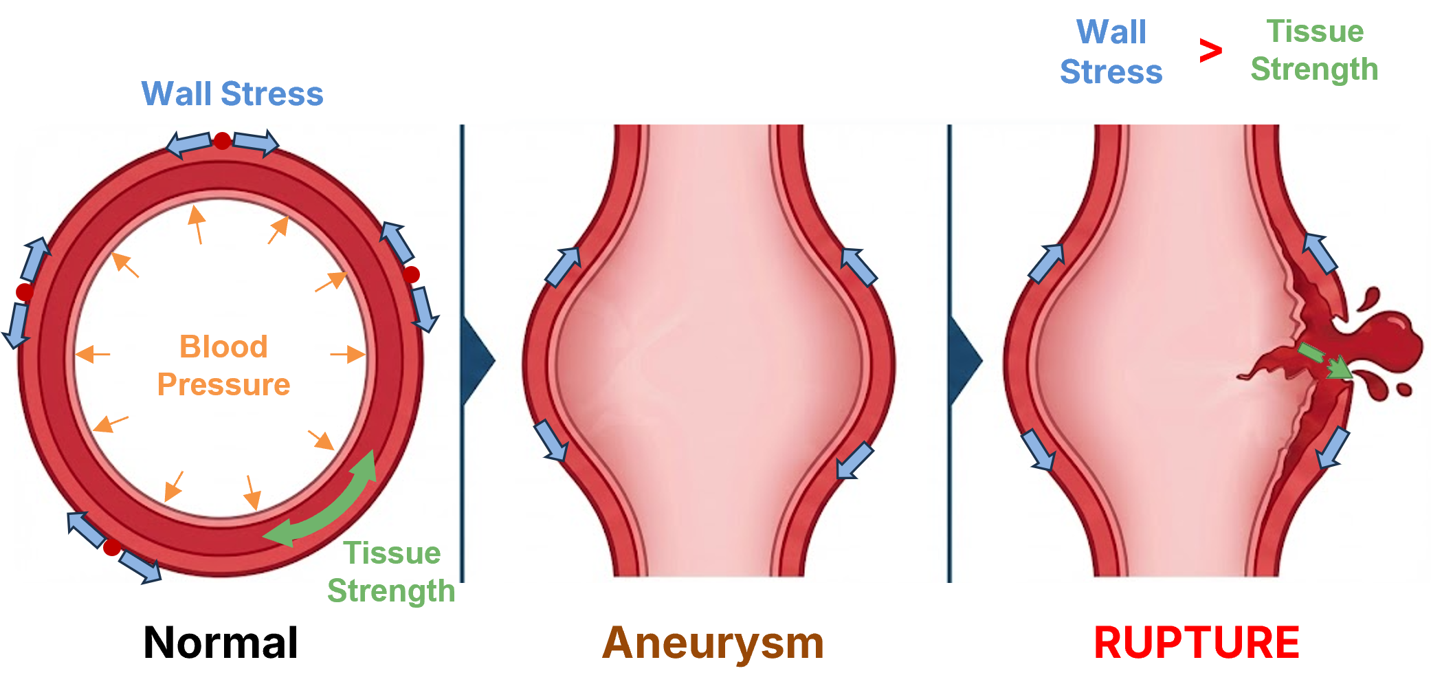 Aortic wall stress distribution