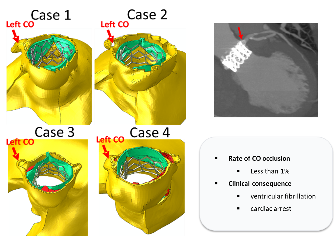 Coronary obstruction analysis