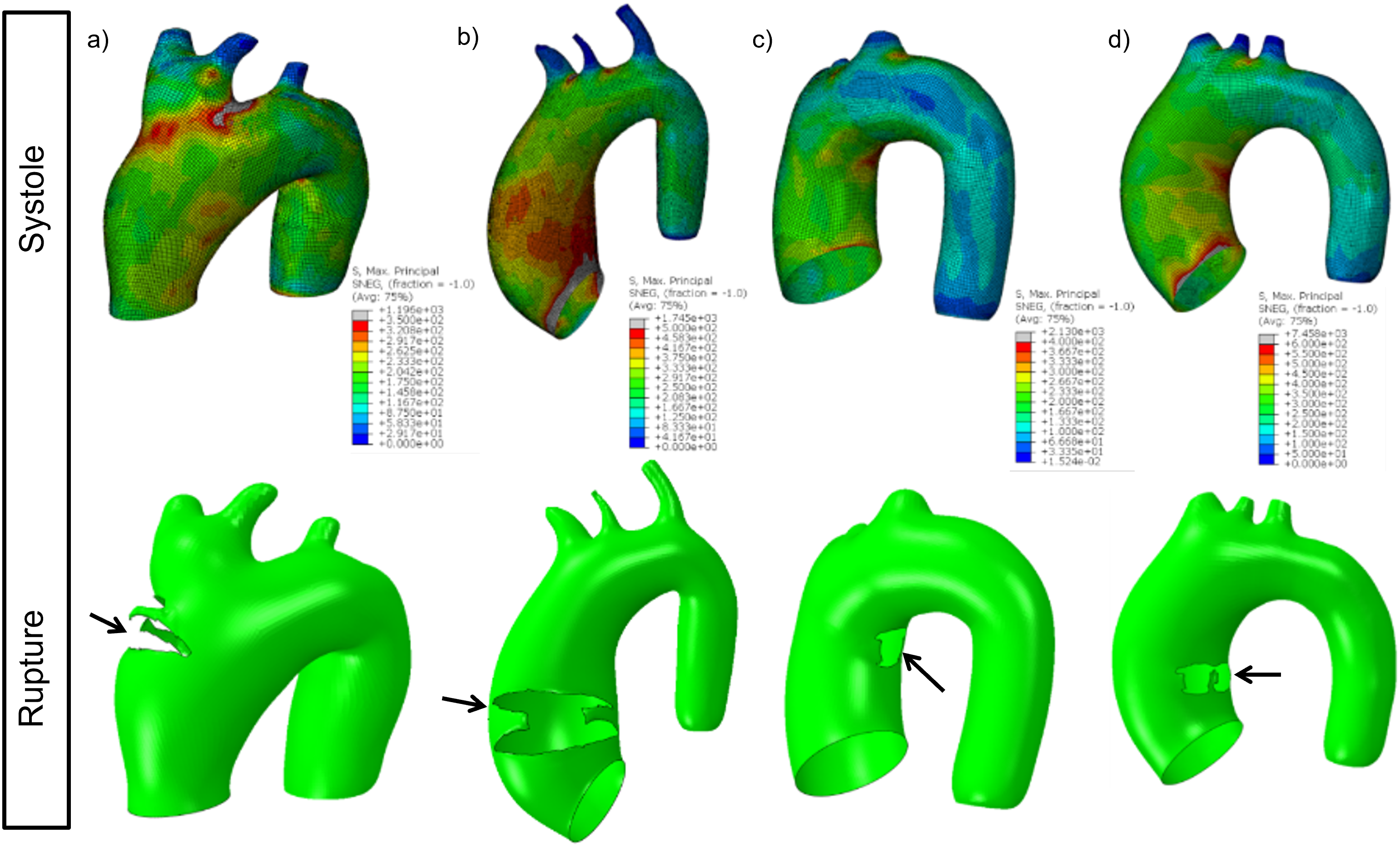 Patient-specific aneurysm analysis